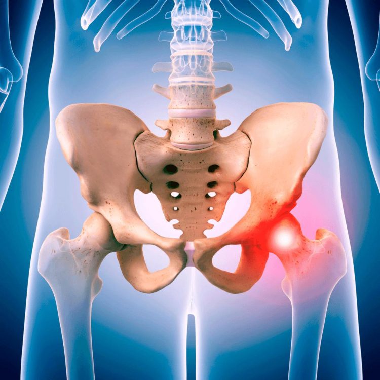 Do you experience hip pain when performing squats?